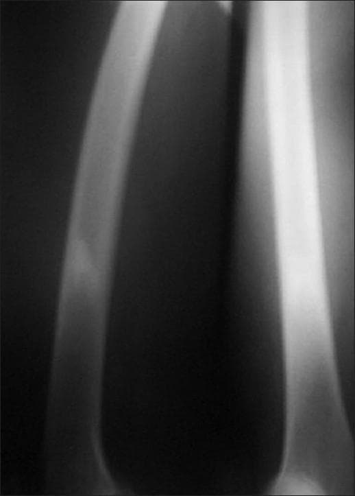 This diagnostic image is a plain radiograph (X-ray) of the right thigh, specifically focusing on the lower shaft of the femur. The radiograph demonstrates a focal area of irregular-shaped, predominantly endosteal sclerosis. The sclerosis is characterized by increased radiopacity (whiteness) within the medullary space of the bone. Notably, there is an absence of an identifiable radiolucent nidus, and there is no visible overlying periosteal reaction or cortical thickening. The surrounding soft tissues appear unremarkable with no signs of inflammation or masses. This visual presentation is typical of certain benign bone lesions, such as an osteoid osteoma where the nidus is obscured by dense reactive sclerosis, though differential diagnoses could include chronic osteomyelitis or a stress fracture. The educational focus is on identifying patterns of bone sclerosis and the importance of further imaging (like SPECT or CT) when a primary lesion is radiographically occult.