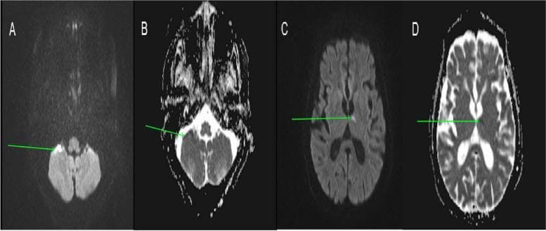 This diagnostic image displays four axial sections of a brain MRI, comparing Diffusion-Weighted Imaging (DWI) and Apparent Diffusion Coefficient (ADC) maps to demonstrate multifocal restricted diffusion. Sections A (DWI) and B (ADC) focus on the posterior fossa, where a hyperintense signal on DWI in the right cerebellar hemisphere corresponds to a hypointense signal on the ADC map (green arrows), indicative of acute cytotoxic edema. Sections C (DWI) and D (ADC) show higher axial levels, highlighting a focal area of increased signal intensity in the left thalamus on DWI with a corresponding signal drop on the ADC map (green arrows). These findings are characteristic of multi-territorial acute ischemic infarcts. The comparison effectively illustrates the inverse relationship between DWI and ADC sequences, a critical concept in neuroradiology for identifying acute stroke and distinguishing restricted diffusion from T2 shine-through.