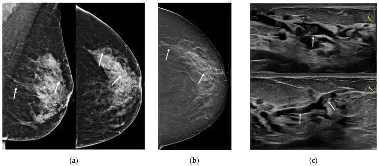 Multi-modal diagnostic imaging of the breast in a 55-year-old patient. (a) Conventional mammography in medio-lateral oblique (MLO) and cranio-caudal (CC) views showing scattered pleomorphic calcifications (indicated by white arrows) within fibroglandular tissue. (b) Digital breast tomosynthesis (DBT) slice in CC view providing enhanced visualization of multiple dilated ducts extending from the retroareolar region toward the outer quadrants. (c) High-resolution ultrasound (US) images depicting prominent, anechoic to hypoechoic dilated ducts containing heterogeneous, echogenic intraluminal material, which may represent solid components or thickened secretions. The findings are characteristic of ductal pathology, such as papillomatosis or duct ectasia, in the clinical context of unilateral bloody nipple discharge. The images illustrate the complementary roles of different imaging modalities in identifying subtle ductal changes and intraluminal contents.