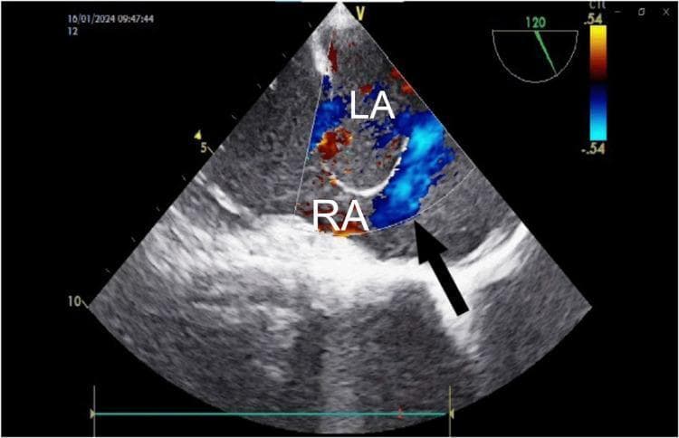 This diagnostic ultrasound image is a mid-esophageal transesophageal echocardiogram (TEE) with color Doppler, focused on the interatrial septum. The image demonstrates a significant atrial septal defect (ASD) associated with an atrial septal aneurysm (ASA). The right atrium (RA) and left atrium (LA) are clearly labeled. A large jet of color flow, predominantly represented in shades of blue, indicates shunting across the septal defect. A black arrow points specifically to the region of the defect where the septal wall is discontinuous, allowing for the passage of blood between the chambers. The color Doppler scale on the right indicates velocity and direction, with the blue flow signifying movement away from the probe (from LA to RA). The interatrial septum displays an aneurysmal bulge toward the right atrium, consistent with pressure differentials often seen in such congenital heart defects. This image serves as a clinical example of using TEE for the evaluation and intraoperative monitoring of septal anomalies and hemodynamics.