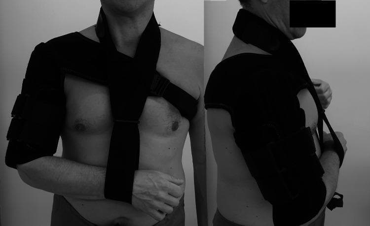 Clinical photograph (anterior and lateral views) showing a prefabricated humeral functional brace (Clasby Humeral Brace) applied to a patient's right upper extremity. The device is a dark, semi-rigid orthosis designed for the conservative management of humerus midshaft fractures. The humeral shell extends from the acromion to just proximal to the elbow crease, composed of overlapping panels secured by circumferential velcro straps to provide soft tissue compression. The suspension system features a wide strap originating from the humeral component, crossing diagonally over the contralateral shoulder, and a secondary stabilization strap crossing the anterior chest. A distal wrist cuff is integrated to support the forearm in a neutral position. This orthosis facilitates fracture stabilization through the principle of hydrostatic compression of the surrounding musculature while allowing motion at the shoulder and elbow joints to prevent stiffness. It is specifically used in orthopedic trauma for patients where surgical intervention is not indicated or as a follow-up to initial coaptation splinting.
