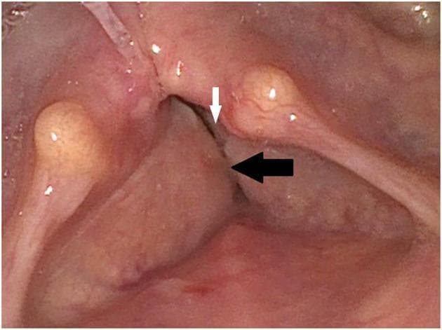 This endoscopic clinical photograph displays the glottal and supraglottal regions of the larynx during laryngoscopy. The image demonstrates bilateral vocal cord palsy, with the true vocal cords (indicated by the white arrow) appearing in a fixed, medial position. The true vocal cords exhibit a narrow glottal gap, suggesting impaired abduction. Positioned superior to the true cords are hyperplastic vestibular folds (false vocal cords, indicated by the black arrow), which appear significantly enlarged and medially displaced. This hyperplasia results in partial obscuration of the underlying true vocal folds. Anatomical landmarks such as the arytenoid eminences and the interarytenoid area are visible but show signs of crowding due to the soft tissue enlargement. This finding is clinically relevant to the diagnosis of bilateral vocal fold immobility and compensatory muscle tension or secondary hyperplasia of the supraglottic structures, which typically presents with symptoms of dyspnea, inspiratory stridor, and dysphonia.