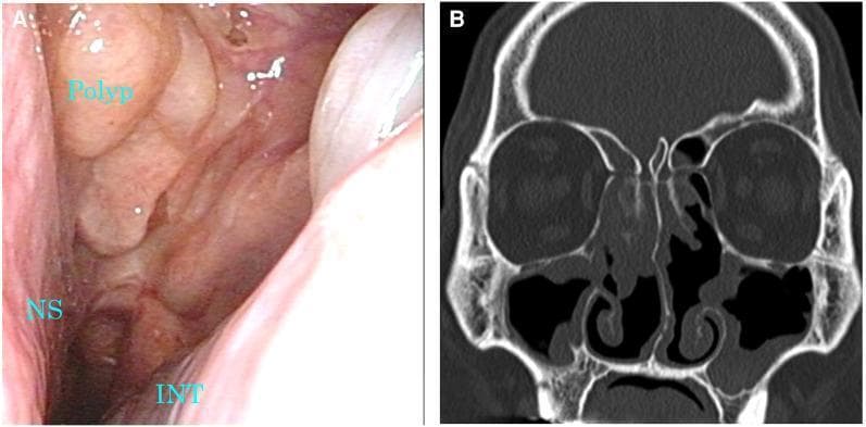 This composite figure displays diagnostic findings of chronic rhinosinusitis with nasal polyps (CRSwNP). Image A is a nasal endoscopy showing a large, pale-pink, fleshy nasal polyp occupying the middle meatus and partially obstructing the nasal passage. Key landmarks include the nasal septum (NS) on the medial side and the inferior nasal turbinate (INT) at the inferior aspect. Image B is a coronal non-contrast CT scan of the paranasal sinuses. It reveals partial opacification and mucosal thickening within the bilateral maxillary, ethmoid, and frontal sinuses. The soft tissue density lesions signify inflammatory polyposis and retained secretions, though significant aeration is visible compared to total opacification. The nasal septum is midline, and the turbinate structures are clearly delineated. These images demonstrate the clinical and radiological presentation of eosinophilic chronic rhinosinusitis (ECRS) and are used to assess the Total Polyp Score (TPS) and Lund-Mackay Score (LMS) in response to treatment, such as biologics like dupilumab.
