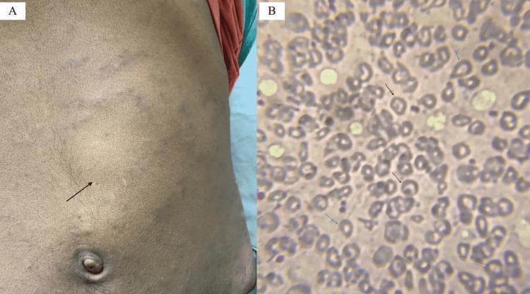 Educational medical image panel consisting of a clinical photograph and a diagnostic pathology image illustrating physical and hematological findings of a hemoglobinopathy such as Hb E/beta-thalassemia. Panel A is a clinical photograph of a patient's abdomen showing a prominent bulge in the left upper quadrant and mid-abdomen, with a black arrow indicating the anterior notch of a massively enlarged spleen (splenomegaly). The overlying skin shows subtle striae or discoloration. Panel B is a peripheral blood smear (Leishman stain, 200x) showing significant red blood cell (RBC) dysmorphology. Key findings include target cells (codocytes) marked by black arrows, teardrop cells (dacrocytes) marked by blue arrows, and basophilic stippling within microcytic, hypochromic RBCs marked by yellow arrows. These visual markers are classic indicators of disordered erythropoiesis and hemoglobin synthesis abnormalities, providing a diagnostic bridge between clinical examination (splenomegaly) and laboratory hematopathology.