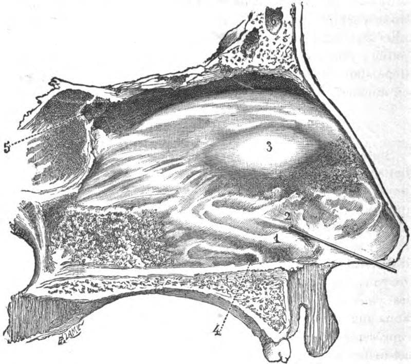 This medical anatomical diagram illustrates a sagittal section of the human nasal septum, highlighting specialized structures of the nasal fossa. Key landmarks are numerically labeled: (1) indicates the 'bead' or Jacobsonian swelling, formed by Jacobson's cartilage in the anteroinferior region; (2) shows the orifice of the Jacobson's canal (vomeronasal organ) with a fine stylet inserted to demonstrate patency; (3) identifies the tubercle of the septum located superior to the bead; (4) marks the nasopalatine infundibulum, the mucosal entrance to the nasopalatine canal; and (5) points to the orifice of the sphenoidal sinus in the posterosuperior aspect. The diagram also visualizes the frontal sinus (6) and the surrounding bony and cartilaginous framework. This illustration is primarily used in otorhinolaryngology and anatomy education to detail the location and morphology of the vestigial vomeronasal organ and associated septal landmarks in adult humans.