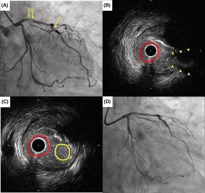 This composite diagnostic image illustrates coronary artery pathology and intravascular assessment in a patient with coronary artery disease. Panel A is a fluoroscopic coronary angiogram showing the left coronary system; arrow A highlights a 75% stenosis in the mid-left anterior descending (LAD) artery, while arrows B and C indicate the anatomical levels corresponding to the subsequent IVUS images. Panels B and C are Intravascular Ultrasound (IVUS) cross-sections. Panel B displays the vessel lumen (red circle) and the ostium of a side branch (yellow arrowheads). Panel C demonstrates a 'double lumen' appearance, where the red circle identifies the main LAD lumen and the yellow circle indicates the side branch lumen separated by an atherosclerotic plaque. Panel D is a fluoroscopic image documenting a failed reverse wire technique during a percutaneous coronary intervention (PCI) attempt. The content is designed for advanced medical education in interventional cardiology, focusing on the integration of angiography and IVUS for evaluating complex bifurcations and stenotic lesions prior to atherectomy and stenting.