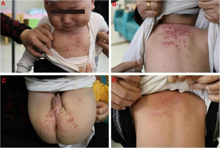 A series of clinical photographs (A-D) demonstrating a pediatric case of varicella-zoster virus (VZV) infection in a 16-month-old male. Panels A-C show the acute phase: (A) demonstrates scattered, erythematous papules on the anterior chest; (B) shows a dense cluster of erythematous papules and vesicles on the upper back and posterior neck, with some lesions exhibiting central umbilication or early crusting; (C) illustrates a similar pleomorphic rash involving the buttocks and genital region. Panel D serves as a comparison, showing the posterior trunk following treatment with acyclovir, where the inflammatory rash has resolved, leaving behind flat, hypopigmented macules and faint scarring. The presentation is characteristic of primary varicella, highlighting a centripetal distribution and the presence of lesions in multiple stages of development. This material is useful for distinguishing VZV from other pediatric exanthems like hand-foot-and-mouth disease (HFMD).