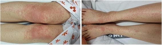 Clinical photograph of a patient's lower extremities demonstrating a widespread erythematous rash, characteristic of a viral exanthem. The left panel shows the thighs and knees, while the right panel shows the lower legs and dorsal feet. The morphology is primarily maculopapular, consisting of small, red, blanchable spots and slightly raised bumps. A distinct spatial variation is visible: the proximal lesions around the knees are highly confluent, forming large, poorly demarcated erythematous patches. In contrast, the distal lesions on the lower legs and feet are more discrete, individual maculopapules with intervening areas of normal-appearing skin. This presentation is consistent with the secondary stage of a Dengue virus infection (DENV-2), appearing several days after initial symptoms. The image serves as a clinical reference for identifying infectious disease-related skin manifestations and assessing the distribution and confluence of exanthematous eruptions.