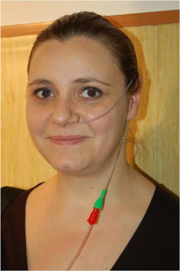 This clinical photograph shows a female patient demonstrating the placement and routing of a small-bore nasogastric or enteral feeding tube. The image highlights a 6-French polyurethane tube, noted for its fine gauge and high transparency, which enhances patient aesthetic tolerance and comfort. The tube is seen emerging from the left nostril, secured across the cheek with transparent adhesive tape, and then looped behind the ear before descending along the side of the neck. The distal portion of the tube features a standard color-coded connector assembly, consisting of a green tapered port followed by a red ridged hub, used for securing the connection to a feeding pump or syringe. This image serves as an educational reference for medical procedures involving long-term enteral nutrition and shows correct methods for securing a nasal tube to minimize visibility and displacement.