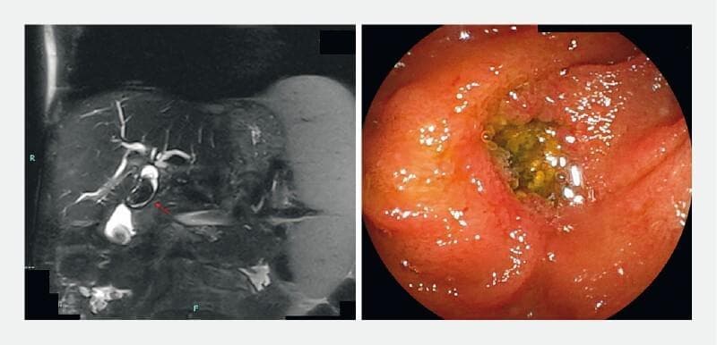 A dual-panel clinical image featuring diagnostic imaging and endoscopy related to hepatobiliary pathology. The left panel shows a Magnetic Resonance Cholangiopancreatography (MRCP) exhibiting a significantly dilated main bile duct measuring approximately 17 mm. A prominent filling defect consistent with a large biliary stone (29x16 mm) is indicated by a red arrow. The MRCP further demonstrates bilateral intrahepatic ductal dilation and a smaller stone in the distal hepatic duct near a surgical anastomosis. The right panel displays a high-definition endoscopic view looking through a hepaticojejunal anastomosis. Within the lumen of the anastomosis, a yellow-brown, multifaceted bile stone is clearly visible. The surrounding mucosa appears intact, and the anastomosis remains patent without evidence of stricture. This composite image illustrates common findings in recurrent biliary lithiasis following hepaticojejunostomy, demonstrating the correlation between radiological findings and direct endoscopic visualization for procedural planning.