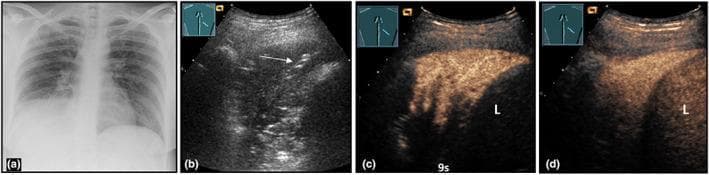 This composite figure illustrates the multimodal diagnostic imaging of community-acquired pneumonia in a 36-year-old female. (a) A posteroanterior chest X-ray reveals a dense, right-sided lower lobe consolidation. (b) B-mode lung ultrasound (LUS) demonstrates a corresponding hypoechoic peripheral consolidation featuring hyperechoic linear structures consistent with air bronchograms (indicated by an arrow). (c) Contrast-enhanced ultrasound (CEUS) at 9 seconds shows early pulmonary arterial perfusion within the lesion. (d) At 2 minutes, the lesion exhibits marked, homogeneous enhancement, reaching an intensity similar to the adjacent liver (L), which serves as a vascular reference. The progression from early arterial perfusion to late homogeneous enhancement is a hallmark of uncomplicated lobar pneumonia. This series demonstrates how CEUS adds functional perfusion data to the structural findings of B-mode LUS, assisting in the differentiation between pneumonic consolidation and other pulmonary pathologies like abscesses or infarcts.