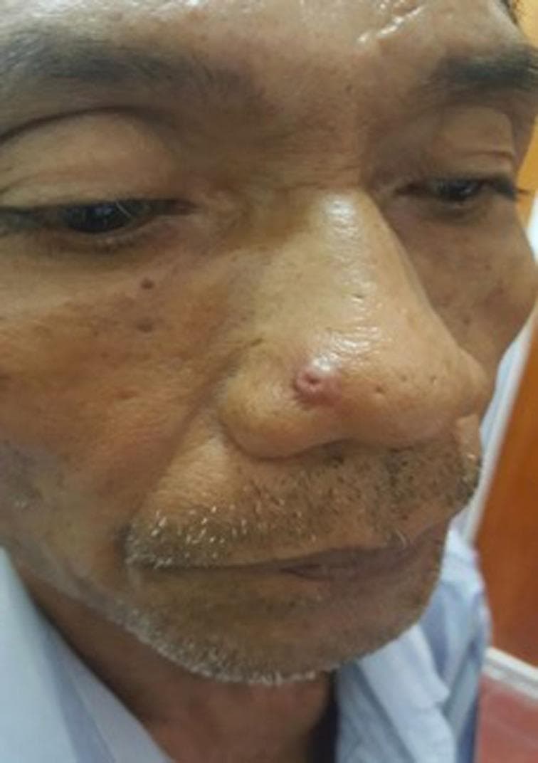 This clinical photograph shows a close-up frontal view of a patient's face, focusing on a solitary, erythematous nodule located on the right nasal sidewall. The primary lesion is approximately 0.5 cm in diameter, well-demarcated, and exhibits a characteristic central ulceration or crateriform appearance. The surrounding nasal skin shows mild erythema and several smaller, non-specific pigmented macules. The background facial skin displays signs of solar elastosis and actinic damage, including uneven texture and dyschromia. This visual presentation is clinically significant for the differential diagnosis of cutaneous neoplasms, particularly keratoacanthoma or basal cell carcinoma, though the pathological diagnosis in this specific case is angiolymphoid hyperplasia with eosinophilia (ALHE). The image serves as an educational resource for identifying umbilicated or ulcerated skin nodules on sun-exposed facial areas in dermatology and oncology curricula.