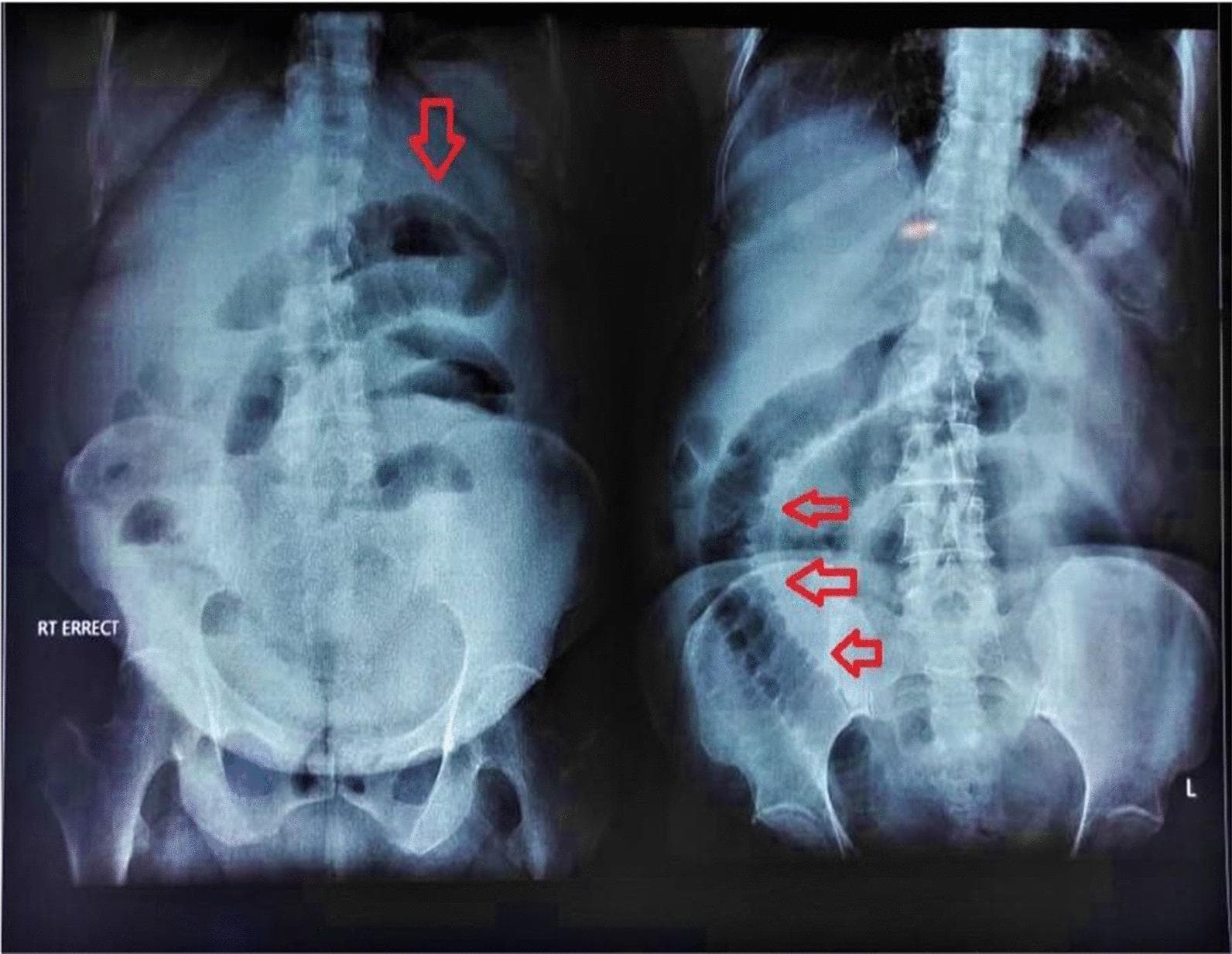 This diagnostic image consists of two views from an erect abdominal X-ray (AXR) demonstrating signs of small bowel obstruction. The radiograph displays multiple centrally located, dilated loops of small intestine. Key anatomical and pathological features are highlighted by red arrows: the jejunal loops are identifiable by the presence of valvulae conniventes (plicae circulares), which appear as thin, transverse radiopaque lines extending across the entire diameter of the bowel lumen. In contrast, the distal small bowel loops, representing the ileum, appear relatively 'featureless' with an absence of prominent mucosal folds. The presence of these dilated loops (exceeding the 3 cm rule) suggests a mechanical obstruction or adynamic ileus. The image serves as a clinical example for differentiating small bowel segments based on mucosal patterns and identifying radiographic markers of intestinal distension and subacute obstruction.