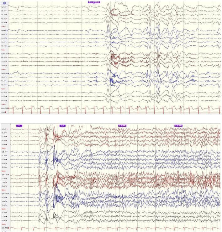 Two multi-channel electroencephalogram (EEG) tracings demonstrating the onset of different seizure types in a patient with Lennox-Gastaut syndrome (LGS). The top segment depicts an epileptic spasm, characterized by a sudden burst of high-amplitude, generalized slow waves followed by relative background suppression and lower-amplitude activity. The bottom segment shows a tonic seizure onset, featuring a transition from interictal slow spike-wave (SSW) complexes to generalized paroxysmal fast activity (GPFA). This generalized activity consists of sustained, high-frequency, rhythmic discharges appearing across all recording channels with minimal localization value. Both segments include an ECG rhythm strip at the bottom for monitoring cardiac synchrony. The images serve as diagnostic examples of the complex ictal patterns associated with refractory epilepsy and encephalopathy, highlighting the transition from intermittent focal-like events to generalized, persistent abnormal cortical discharges.