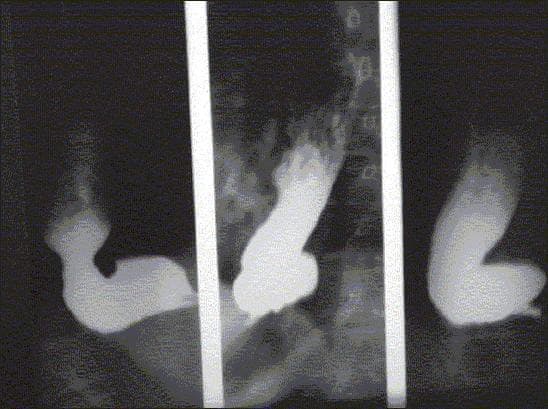 This diagnostic image is a barium swallow (barium meal) radiograph demonstrating classic features of advanced achalasia. The esophagus is severely dilated with a tortuous, 'sigmoid' morphology, indicative of chronic obstruction and loss of esophageal peristalsis (megaesophagus). At the distal end, the esophagus terminates in a smooth, tapered narrowing at the gastroesophageal junction, creating the characteristic 'bird's beak' appearance. This finding represents a failure of the lower esophageal sphincter (LES) to relax, leading to the pooling of contrast material and food within the thoracic esophagus. The image illustrates the anatomical and functional changes associated with esophageal motility disorders, specifically the late stages of achalasia where the organ becomes decompensated and redundant. It serves as a key clinical example for medical students and residents in gastroenterology and radiology for identifying esophageal outflow obstruction.