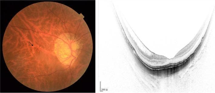 The visual content consists of a side-by-side comparison of a color fundus photograph and a cross-sectional optical coherence tomography (OCT) scan of a highly myopic eye. The fundus image on the left displays a classic 'tessellated' background, where thinning of the retinal pigment epithelium makes the underlying choroidal vessels prominently visible. A black arrow indicates 'lacquer cracks,' which represent linear ruptures in Bruch's membrane. A prominent peripapillary conus is also visible adjacent to the optic disc, characteristic of axial myopia. The OCT scan on the right demonstrates pathological changes in macular architecture, specifically inner foveoschisis characterized by intraretinal splitting or separation of the neurosensory retinal layers. The scan also reveals a significantly concave posterior staphyloma contour. This combined imaging set is essential for the diagnosis and staging of pathologic myopia, illustrating key complications like myopic traction maculopathy and degenerative Bruch's membrane changes. It serves as an educational tool for ophthalmology students and residents to differentiate between stages of myopic maculopathy using the ATN classification system.