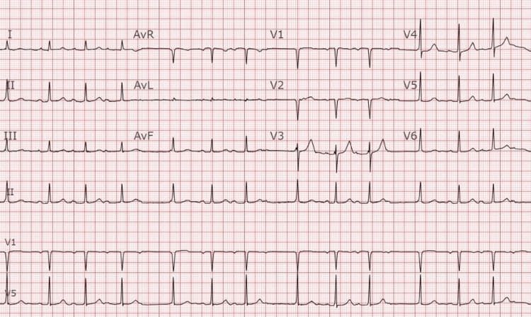 This diagnostic image is a 12-lead electrocardiogram (ECG) printed on standard grid paper, displaying leads I, II, III, aVR, aVL, aVF, and V1-V6, including long rhythm strips for leads II, V1, and V5. The tracing demonstrates classic features of Second-Degree Atrioventricular (AV) Block, Mobitz Type I (Wenckebach phenomenon). The primary diagnostic hallmark visible in lead II is the progressive lengthening of the PR interval over successive cardiac cycles until a P wave fails to conduct to the ventricles, resulting in a 'dropped' QRS complex. Following the non-conducted P wave, the PR interval resets to its shortest duration and the cycle repeats. The QRS complexes are relatively narrow with a normal morphology, and P-wave morphology remains consistent. The ST segments are isoelectric without significant elevation or depression. This ECG is a key educational resource for identifying AV nodal conduction delays and distinguishing between different types of second-degree heart blocks in a clinical cardiology context.