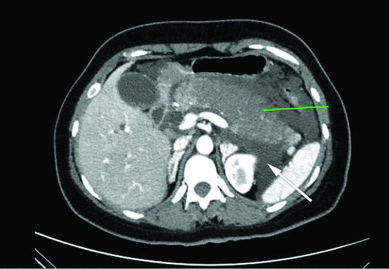 Axial contrast-enhanced computed tomography (CT) scan of the upper abdomen demonstrating severe acute necrotizing pancreatitis. The primary pathology involves the body and tail of the pancreas (indicated by a green arrow), which appear enlarged with heterogeneous parenchymal enhancement, suggestive of necrosis. Surrounding the pancreatic tissue is an extensive acute peripancreatic fluid collection (indicated by a white arrow), characterized by low-density, irregular margins. This collection occupies the peripancreatic space and extends into the pararenal spaces, causing displacement of the stomach and partial compression of the spleen and left kidney. Other visible anatomical structures include the liver, gallbladder, and abdominal aorta. This imaging study is characteristic of advanced acute pancreatitis complications and is used to assess the severity of pancreatic necrosis and the presence of localized fluid collections for clinical staging and intervention planning.
