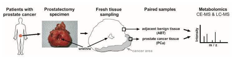 A scientific illustration and clinical photograph summarizing the research workflow for metabolomic analysis of prostate cancer (PCa). The process begins with 'Patients with prostate cancer', represented by a human silhouette. This leads to the 'Prostatectomy specimen', shown via a gross clinical photograph of an excised prostate gland with the central urethra clearly labeled. The next stage, 'Fresh tissue sampling', uses an anatomical diagram of the gland's cross-section to identify a specific shaded 'cancer area'. From this section, 'Paired samples' are extracted: adjacent benign tissue (ABT) and prostate cancer tissue (PCa). The final stage, 'Metabolomics', depicts the analysis of these paired samples using capillary electrophoresis-mass spectrometry (CE-MS) and liquid chromatography-mass spectrometry (LC-MS), represented by a mass spectrum graph showing intensity versus m/z ratio. This workflow illustrates the methodology for comparing metabolite profiles between malignant and benign prostatic tissues to identify biomarkers or metabolic pathways involved in cancer progression.