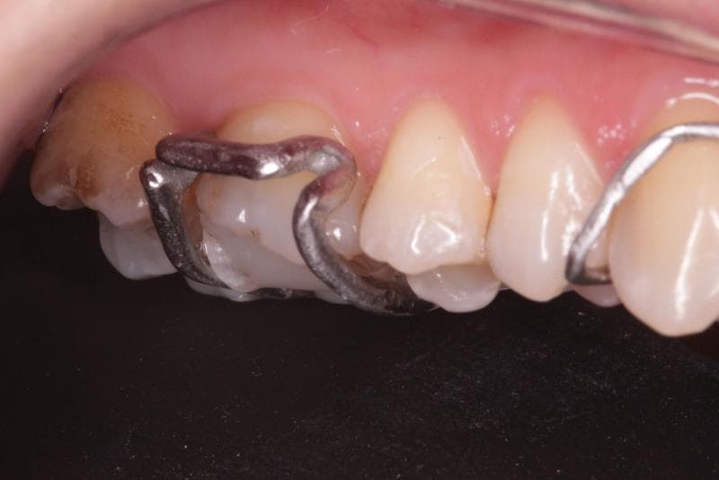 This intraoral clinical photograph displays a metallic dental appliance, specifically an Adams clasp, fitted to the maxillary teeth. The appliance is fabricated from a cobalt-chromium (Co-Cr) alloy, featuring a polished metallic finish. The primary focus is on the 'arrowhead' components of the clasp, which are U-shaped and precisely adapted to engage the proximal undercuts of the first molar. These arrowheads are connected by a horizontal bridge that sits at a approximately 45-degree angle from the buccal surface of the tooth to avoid soft tissue irritation. The surrounding gingival tissues appear pink and healthy, indicating good biocompatibility and fit. The first molar exhibits signs of prior restorative work and surface discoloration. The labial bow of the appliance is also visible extending toward the anterior teeth. This image demonstrates the clinical application of digital design and selective laser melting (SLM) in the production of orthodontic retainers, highlighting the relationship between appliance retention and tooth anatomy.