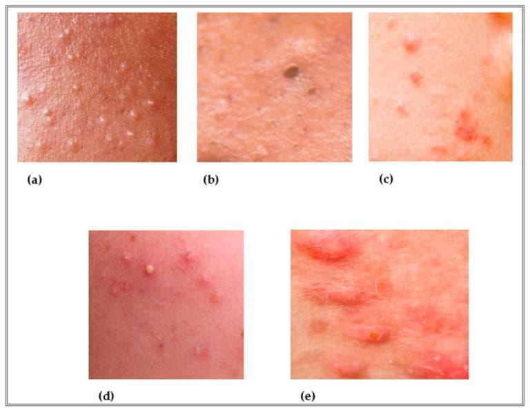 This composite clinical photograph illustrates the morphological spectrum of acne vulgaris, organized by lesion type and increasing severity. The images provide a comparative visualization of non-inflammatory and inflammatory dermatological findings: (a) Closed comedones (whiteheads) presenting as small, flesh-colored, non-inflammatory sub-epidermal bumps; (b) Open comedones (blackheads) characterized by dilated follicular orifices with dark oxidized keratinous material; (c) Erythematous papules representing early inflammatory lesions without visible suppuration; (d) Pustules demonstrating localized purulent material at the lesion apex surrounded by an inflammatory halo; and (e) Nodular acne featuring large, deep-seated, painful inflammatory lesions extending into the dermis. This sequence serves as an educational tool for clinical grading, transitioning from mild comedonal acne to moderate papulopustular and finally severe inflammatory nodular stages. The visual features highlighted include changes in lesion morphology, diameter, color (from flesh-toned to intense erythema), and the transition from non-inflammatory follicular plugging to deep dermal inflammation.