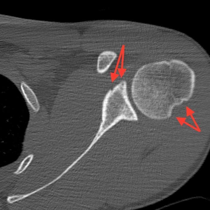 This diagnostic image is an axial cross-section from a non-contrast computerized tomography (CT) scan of the left shoulder. It demonstrates the bony anatomy of the glenohumeral joint, showing findings characteristic of chronic anterior shoulder instability. Two specific pathologies are highlighted with red arrows: 1. A Bankart lesion (bony type) appearing as mild compression or blunting of the anterior glenoid rim, extending approximately 1.1 cm. 2. A Hill-Sachs lesion, seen as a posterolateral compression fracture or 'dent' in the humeral head, measuring roughly 1.4 cm x 0.3 cm. The CT scan effectively illustrates these reciprocal injuries typically caused by recurrent anterior dislocations, where the humeral head impacts against the anterior glenoid. This content is suitable for orthopedic and radiology education, focusing on diagnostic markers of shoulder instability and surgical planning considerations such as the degree of bone loss.