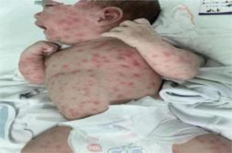 This clinical photograph displays a newborn infant in a neonatal care setting presenting with a widespread dermatological manifestation. The image depicts a diffuse, erythematous maculopapular rash consisting of individual, red, slightly raised lesions. The rash demonstrates extensive distribution, covering a high density on the face, scalp, and ears, while also involving the torso, upper extremities, and thighs. The clinical presentation is consistent with scarlet-like dermatitis or neonatal lupus erythematosus, particularly given the mention of positive ANA, SS-A, and SS-B antibodies in the context. The photograph serves as a visual reference for pediatric dermatology and neonatology, illustrating the morphology and generalized pattern of inflammatory skin conditions in a preterm infant. The background includes standard medical linens, emphasizing the clinical environment.