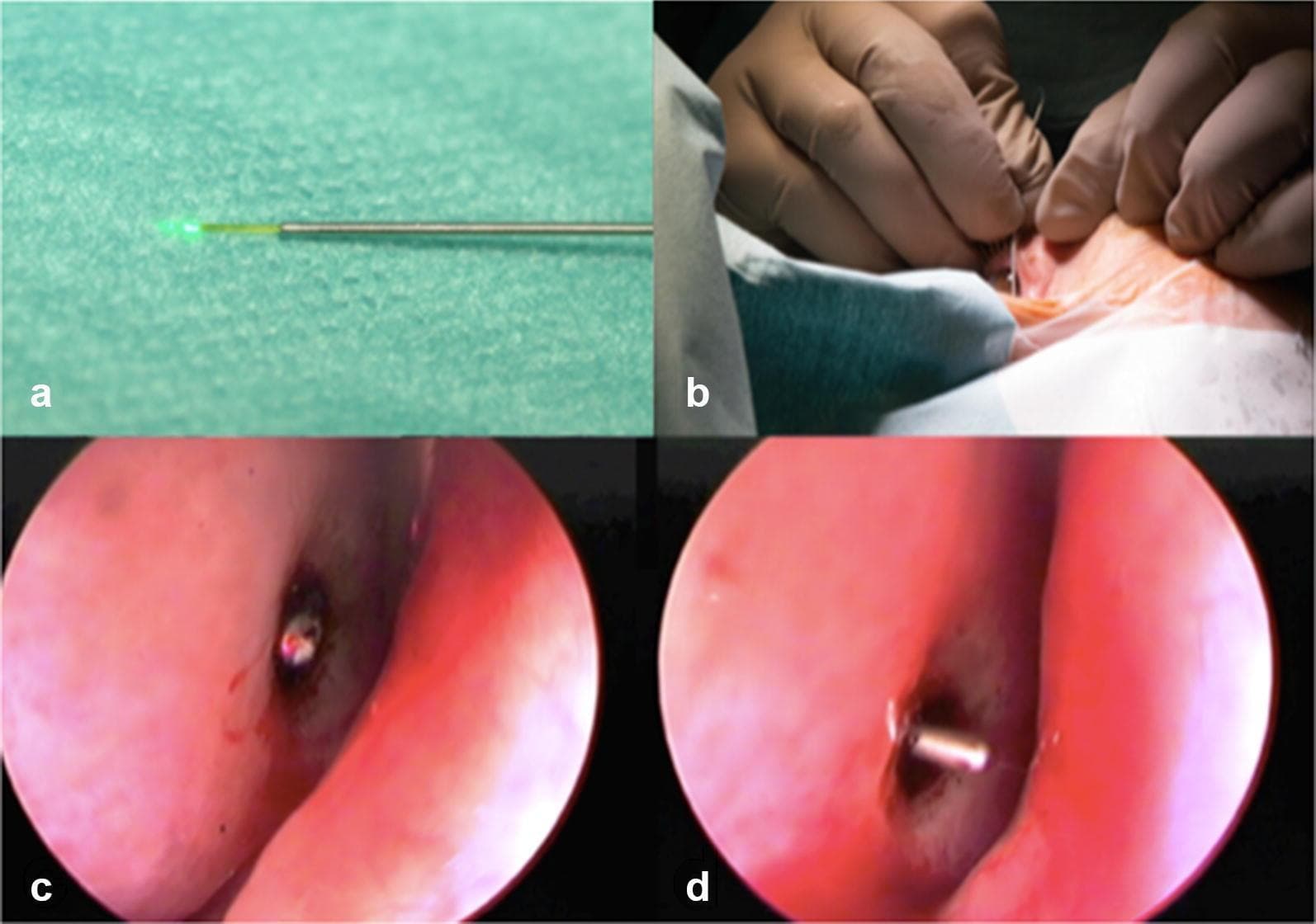 This four-panel image illustrates a laser-assisted dacryocystorhinostomy (DCR) procedure for treating nasolacrimal duct obstruction. Panel A shows a 300µm metallic laser fiber optic emitting a green aiming beam, used for precise tissue targeting. Panel B depicts the external surgical field where a surgeon, wearing sterile gloves, manipulates the laser fiber through the lacrimal canaliculus in a mediorostral orientation near the medial canthus. Panels C and D provide endonasal endoscopic views of the nasal cavity mucosa. Panel C demonstrates transillumination, where the green laser light is visible through the nasal mucosa at the anteroinferior rim of the middle turbinate just before breaching the bone to create a bony ostium. Panel D shows the subsequent step where a blunt metal probe is used to guide a silicone intubation tube through the newly formed ostium to ensure long-term patency of the bypass. This sequence highlights the minimally invasive transcanalicular approach to lacrimal surgery using 810-nm diode laser technology.