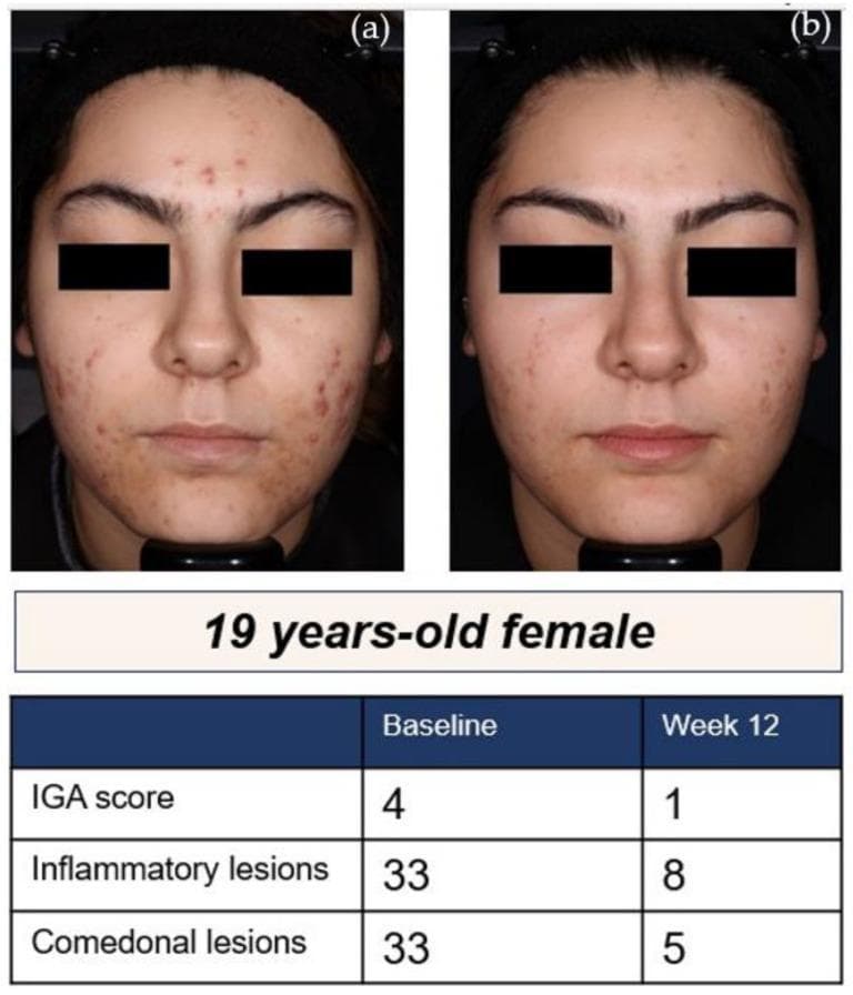 This clinical photograph set demonstrates the therapeutic response of moderate-to-severe acne vulgaris in a 19-year-old female patient. The composite image includes a baseline photograph (a) and a follow-up photograph (b) after 12 weeks of treatment with the narrow-spectrum tetracycline antibiotic, sarecycline. At baseline, the patient presents with numerous inflammatory papules, pustules, and comedones distributed across the forehead, cheeks, and chin, corresponding to an Investigator's Global Assessment (IGA) score of 4. The 12-week post-treatment image shows a significant reduction in lesion count and severity, reflecting an IGA score of 1 (almost clear). An accompanying data table quantifies this improvement, showing a reduction in inflammatory lesions from 33 to 8 and comedonal lesions from 33 to 5. The images highlight clinical features such as erythema, inflammatory morphology, and post-inflammatory changes, serving as a visual case study for dermatological pharmacological efficacy and acne management.