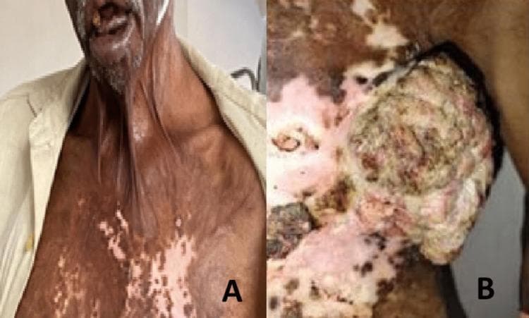 This clinical photograph consists of two panels (A and B) demonstrating long-term sequelae of severe burn injuries. Panel A is an anterior-view clinical photograph of a patient showing a significant post-burn neck contracture, characterized by vertical bands of tightened, shortened skin extending from the chest to the chin, causing eversion of the lower lip (ectropion). The chest skin displays extensive mottled dyspigmentation with areas of hyperpigmentation and hypopigmentation, consistent with an unstable chronic scar. Panel B is a close-up of the left chest wall and axillary region, revealing a large (approximately 15 cm x 10 cm), exophytic, fungating mass arising from the scarred tissue. The lesion presents a cauliflower-like or cobblestone texture with variegated colors indicating areas of necrosis, purulent discharge, and potential hemorrhage. This presentation is highly clinically significant for the development of a Marjolin ulcer—a squamous cell carcinoma arising within a site of chronic inflammation or previous thermal injury. The image serves as an educational tool for identifying late burn complications and malignant transformation in chronic scars.