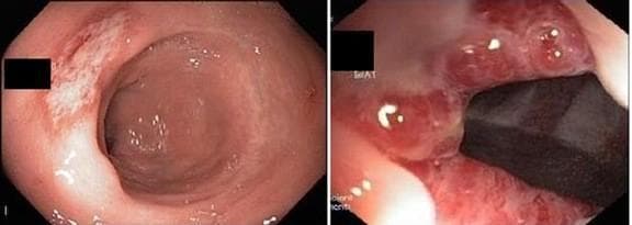 This composite of two endoscopic images demonstrates common rectal pathologies. The top image shows a Solitary Rectal Ulcer (SRU), characterized by a shallow, irregular-shaped lesion with a pale, whitish-grey fibrin base and surrounding erythematous, hyperemic mucosa. The lesion appears flat rather than excavated. The bottom image shows internal hemorrhoids, appearing as multiple, prominent, bulging columns of tissue protruding into the rectal lumen. These hemorrhoids exhibit significant vascular congestion, visible as a deep red or purplish discoloration with a smooth, glistening mucosal surface. The images illustrate the clinical distinction between ulcerative inflammatory processes and vascular-based structural abnormalities in the anorectal region. These findings are clinically significant in the diagnostic workup for symptoms such as bleeding per rectum, tenesmus, and chronic constipation. The content is suitable for medical students and gastroenterology trainees learning to identify anorectal disorders via lower gastrointestinal endoscopy.