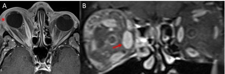 This diagnostic image consists of two panels (A and B) featuring fat-suppressed, contrast-enhanced T1-weighted MRI scans of the orbits, illustrating findings characteristic of orbital cellulitis. Panel A is an axial view showing significant preseptal soft tissue swelling (marked by a red asterisk), visible as hyperintense thickening anterior to the right globe. The right medial rectus muscle is notably enlarged and exhibits increased enhancement, accompanied by right axial proptosis (anterior displacement of the globe). Panel B is a coronal view highlighting the significant fusiform enlargement of the right medial rectus muscle (indicated by a red arrow). There is also evidence of intraconal fat stranding, characterized by streaky, hyperintense signal alterations within the normally suppressed orbital fat, signifying active inflammation and edema. These findings collectively demonstrate the hallmark radiological features used to differentiate orbital cellulitis from preseptal cellulitis and other inflammatory orbitopathies like thyroid eye disease.