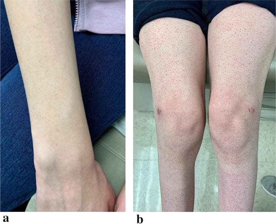 Clinical photograph consisting of two panels (a and b) demonstrating dermatologic and musculoskeletal signs of vitamin C deficiency (scurvy). Panel a shows the anterior forearm with a faint, erythematous perifollicular rash characterized by small, reddish macules centered around hair follicles. Panel b displays the bilateral lower extremities, exhibiting a more prominent and diffuse perifollicular petechial rash extending from the thighs to the lower legs. Significant bilateral knee swelling (effusions) is visible, along with small, horizontal, linear scars on the anterior knees consistent with healed biopsy incisions. The skin findings illustrate classic hemorrhagic manifestations of scurvy, where capillary fragility leads to perifollicular hemorrhage. This visual evidence is used in medical education to identify nutritional deficiencies in patients with restrictive eating habits, highlighting the triad of perifollicular petechiae, corkscrew hairs (as described in clinical context), and joint swelling due to hemarthrosis or effusions.
