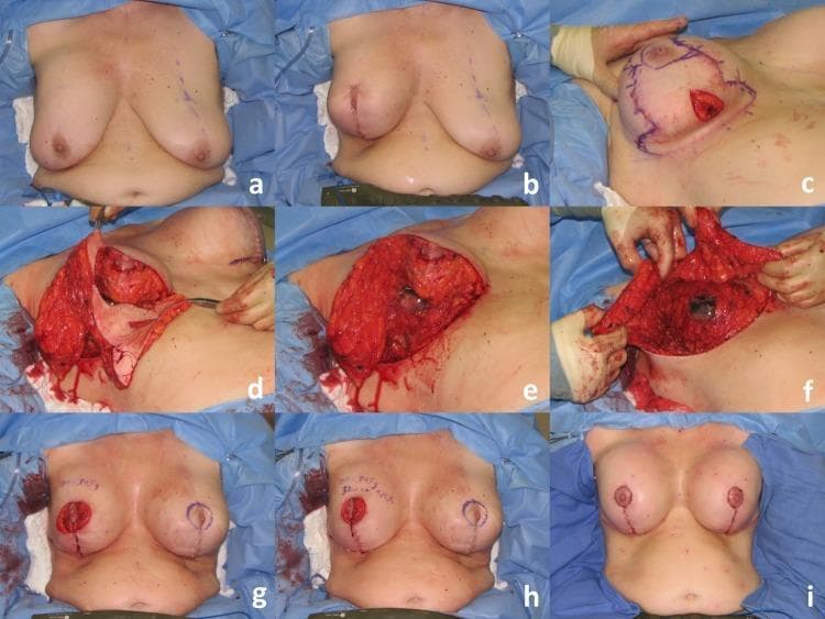This nine-panel clinical photographic sequence (a-i) documents a reductive augmentation mammaplasty, a plastic surgery procedure combining breast reduction and implant placement. Panels a-c show the initial preoperative state and the 'tailor-tack' mastopexy technique using surgical staples and surgical markings to define the superomedial pedicle and planned incisions. Panels d-f illustrate the intraoperative tissue management: the surgical excision of a significant parenchymal specimen (initial 220g) from the lower pole, followed by thinning and further excision (additional 115g) of the lateral and medial skin flaps to create space for the prosthesis. The exposed breast anatomy demonstrates the relationship between the skin envelope, subcutaneous fat, and glandular tissue. Panels g-h show the re-approximation of tissue with temporary staples to assess symmetry and volume. The final panel (i) displays the postoperative result in a sitting position, demonstrating the final vertical scar closure, nipple-areolar complex repositioning, and improved upper pole fullness achieved via the permanent 470cc silicone implant.