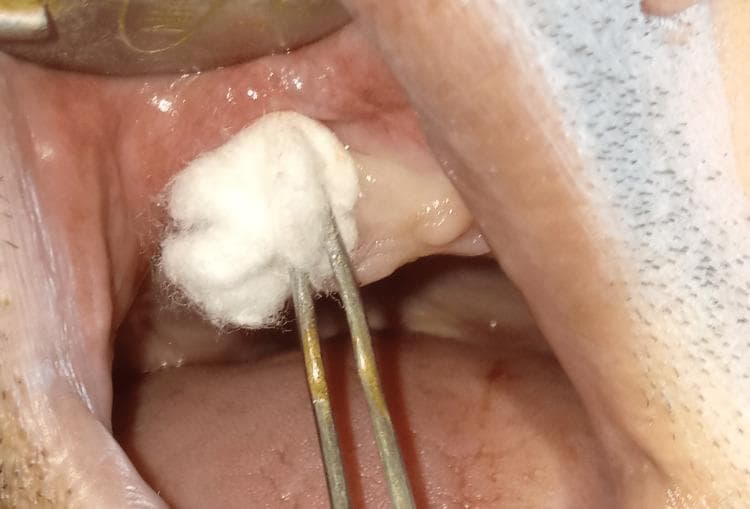 A close-up clinical photograph showing a post-operative procedural step within the human oral cavity. The image focuses on an extraction site in the maxillary alveolar ridge. A pair of metal dental tweezers (forceps) is visible, holding a white cotton pledget or ball. The cotton is being applied directly to the socket of a recently extracted tooth, which serves as the delivery medium for a topical treatment, such as ozonized olive oil. The surrounding gingival tissue appears pink and slightly edematous, consistent with immediate post-extraction healing. The buccal mucosa and palatal tissue are partially visible, alongside a dental retractor used to provide clear visualization of the surgical site. The image demonstrates post-operative care and wound management techniques in oral and maxillofacial surgery, specifically the localized application of therapeutic agents to promote socket healing and manage inflammation.