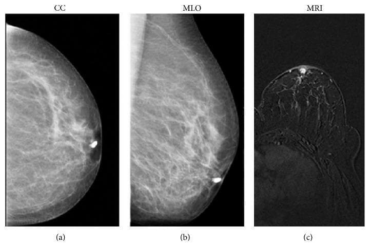 Multi-modal diagnostic imaging of the breast in a 53-year-old patient with nipple discharge, including galactography and MRI. Panel (a) and (b) present craniocaudal (CC) and mediolateral oblique (MLO) mammographic views during a galactogram, demonstrating a 'filling stop' in a cannulated duct located in the retroareolar region, a few millimeters from the nipple. Panel (c) shows a T1-weighted 3D FLASH axial MRI image of the same breast, highlighting a small, enhancing mass within the ductal system. The MRI finding is characterized by a round shape with sharp, well-defined margins in the retroareolar area. These combined findings are pathognomonic for an intraductal papilloma, a benign epithelial proliferation. This comparison illustrates the clinical utility of integrating ductography and contrast-enhanced MRI for localizing small intraductal lesions that may be difficult to characterize on standard mammography alone.