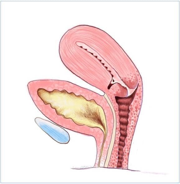 This medical illustration presents a sagittal cross-section of the female pelvis, specifically focusing on the uterus in an anteverted position. The diagram highlights the pathophysiology of a 'uterine niche' or caesarean scar defect. A distinct triangular pouch or sacculation is visible at the anterior uterine isthmus, corresponding to a previous caesarean section scar site. The illustration demonstrates the accumulation of dark yellow/brown menstrual debris within both the endometrial cavity and the niche itself. This sequestered debris is shown distal to the uterine body, explaining the mechanism of post-menstrual spotting due to impaired drainage and lack of coordinated muscular contraction at the scar site. Anatomical structures shown include the uterine corpus, cervix, vaginal canal, and the adjacent urinary bladder (represented in blue). The educational focus is on the anatomical deformity of the lower uterine segment and its clinical relevance to abnormal uterine bleeding patterns following caesarean delivery.