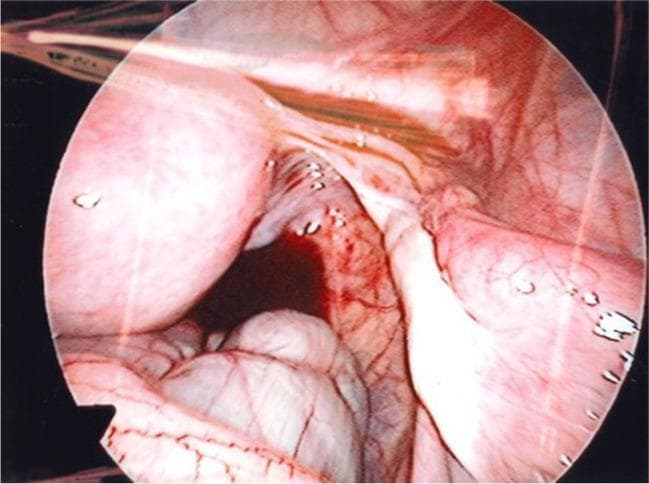 This endoscopic clinical photograph displays an intraoperative view of the female pelvic cavity during a laparoscopic ovarian cortex biopsy. Centrally, the uterus is visible as a smooth, rounded, pinkish organ. Extending from the right uterine horn is a healthy right Fallopian tube, characterized by its elongated, tubular structure and fine superficial vascularity. Adjacent to the Fallopian tube is the right ovary, which appears relatively small but shows typical pinkish coloration and a slightly nodular surface texture. Supporting ligaments, including the broad ligament, are seen as thin, translucent membranous tissues. The anatomical landmarks demonstrate a normal pelvic orientation with no evidence of major adhesions or large cysts. This image serves as a clinical example of pelvic anatomy in the context of fertility preservation procedures, particularly for patients with mosaic Turner syndrome where ovarian reserve may be diminished despite seemingly normal gross anatomy.