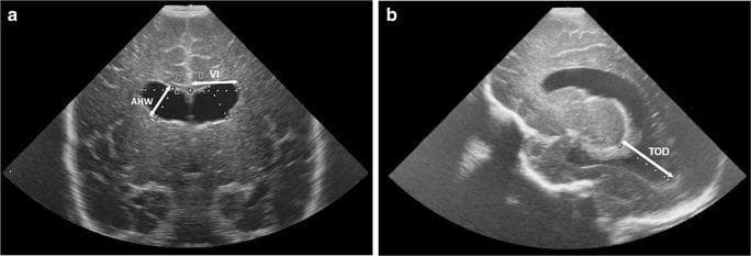 Cranial ultrasound (US) images of a preterm neonate demonstrating standardized linear measurements for assessing post-hemorrhagic ventricular dilatation. Image (a) is a coronal US scan showing measurements of the lateral ventricles: the Ventricular Index (VI), measured as the distance from the falx cerebri to the lateral wall of the anterior horn; and the Anterior Horn Width (AHW), measured as the maximum diagonal width of the anterior horn. Image (b) is a parasagittal US scan demonstrating the Thalamo-occipital Distance (TOD), measured from the posterior junction of the thalamus and choroid plexus to the outermost margin of the occipital horn. The images show significant ventricular enlargement and rounded morphology of the anterior horns, characteristic of hydrocephalus following germinal matrix-intraventricular hemorrhage (GM-IVH). These standardized 2D measurements are critical clinical tools in neonatal neurology for monitoring ventricular volume changes and determining the need for neurosurgical intervention, such as ventricular tapping or reservoir placement.