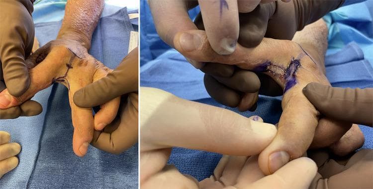 Two side-by-side intraoperative clinical photographs demonstrate the surgical management of a post-burn webspace contracture in a 32-year-old male. The image on the left shows the dorsal view of the hand, highlighting a severe second webspace contracture between the index finger and thumb, with visible surgical marking ink outlining planned incisions. The surrounding skin exhibits hyperpigmentation and pebbled texture consistent with mature split-thickness skin grafts (STSG) from prior burn treatment. The image on the right shows the immediate postoperative result following an ulnar-sided index finger transposition flap. Visible sutures are present along the newly reconstructed webspace, where the flap has been rotated to increase the depth and breadth of the web. A full-thickness skin graft has been applied to the donor site on the index finger. These images illustrate reconstructive techniques for restoring hand function and range of motion following cicatricial contracture.