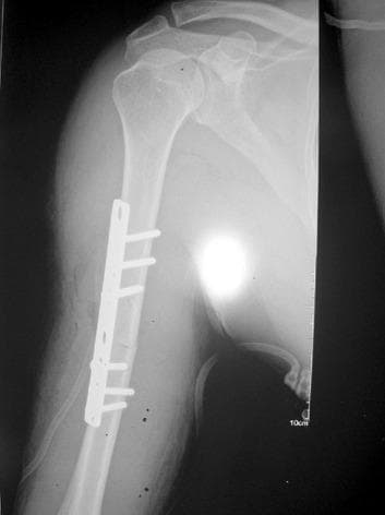 Anteroposterior (AP) radiograph of the right shoulder and humerus demonstrating post-surgical management of a complex upper limb injury. The image shows the glenohumeral joint, acromion, and clavicle. The proximal humerus is reduced within the glenoid fossa, indicating successful management of a prior anterior dislocation. Along the mid-diaphyseal region of the humerus, an orthopedic internal fixation device is visible, consisting of a metallic compression plate secured with multiple cortical screws across a transverse fracture site. The hardware provides stabilization and alignment of the humeral shaft. Key anatomical landmarks include the humeral head, scapular glenoid, and humeral diaphysis. This imaging serves as an educational example of managing ipsilateral shoulder dislocation and humeral shaft fracture using open reduction and internal fixation (ORIF).
