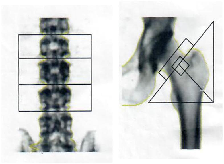 This diagnostic image displays dual-energy X-ray absorptiometry (DEXA) scans used for Bone Mineral Density (BMD) assessment. The visual is divided into two clinical views: an anteroposterior (AP) view of the lumbar spine and a proximal femur scan. In the lumbar spine image, horizontal rectangular Regions of Interest (ROIs) are demarcated over the L2, L3, and L4 vertebrae to calculate specific density values. The right image shows the proximal hip, featuring geometric overlays that isolate the femoral neck, Ward's triangle, and the greater trochanter for analysis. These scans are critical in diagnosing metabolic bone diseases such as osteopenia, osteoporosis, or osteomalacia, which in this clinical context relates to drug-induced renal impairment and hypophosphatemia. The grayscale variations within the skeletal structures represent the relative mineral density, where higher-density cortical bone appears darker compared to more lucent trabecular areas.