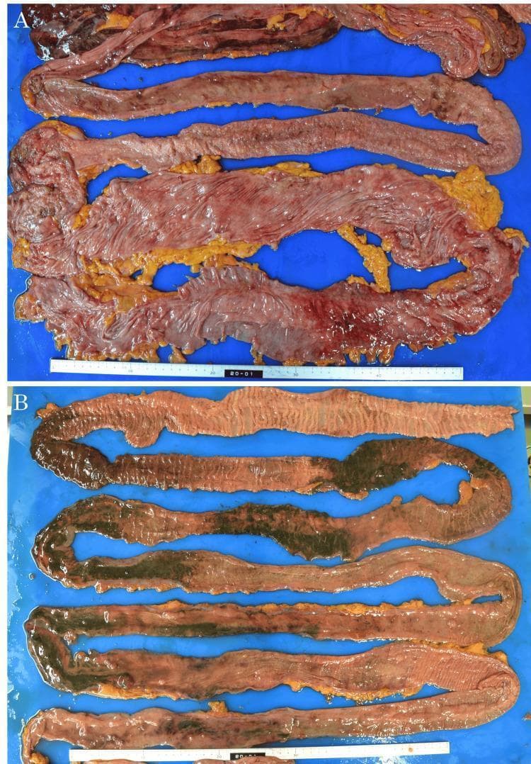 Gross pathological clinical photographs of intestinal specimens obtained during autopsy, illustrating manifestations of nonocclusive intestinal ischemia (NOII). Panel A displays the large intestine, showing significant ischemic changes characterized by diffuse mucosal redness, congestion, and hemorrhagic areas against a background of yellowish adipose tissue. The intestinal wall appears thinned with loss of normal vascular patterns. Panel B demonstrates the small intestine, featuring extensive, transmural necrosis. The pathology is characterized by a distinctive 'speckled' pattern of gangrenous necrosis, where dark green to black necrotic tissue segments are interspersed with lighter, pinkish-tan viable or less severely affected tissue. This necrotic involvement is extensive, spanning approximately 3 meters of the small bowel. Both images highlight the macroscopic appearance of severe bowel infarction and mucosal compromise resulting from septic shock-induced hypoperfusion. A ruler is present at the bottom of each panel for scale.