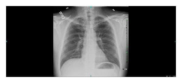 A posterior-anterior (PA) chest X-ray illustrating the thoracic cavity and skeletal structures. The radiograph reveals a distinct anatomical anomaly: a hypoplastic or unusually small right first rib compared to the contralateral side. The primary anatomical landmarks are visible, including the clavicles, rib cage, and vertebral column. The lung fields appear largely clear and radiolucent, with normal bronchovascular markings. The cardiac silhouette is centrally located with well-defined borders and normal size. The diaphragmatic domes are intact, with a clear gastric air bubble visible beneath the left hemidiaphragm. Near the left clavicle, a radiopaque marker or artifact is noted. Clinically, such variations in the first rib anatomy are significant in the context of thoracic outlet syndrome or venous compression (Paget-Schroetter syndrome). This diagnostic image serves as an educational example of rib morphology variations and their potential relationship to vascular pathologies in the thoracic inlet.