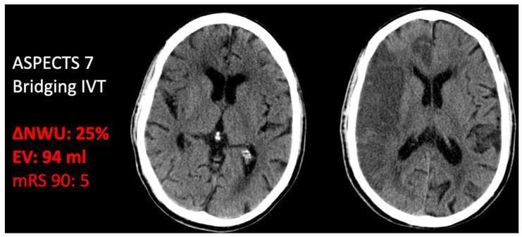 This diagnostic image displays two side-by-side axial non-contrast CT scans of the brain, demonstrating the progression of ischemic stroke and associated cerebral edema. The scan on the left (initial admission) shows subtle signs of early ischemia with an ASPECTS score of 7, indicating early parenchymal changes. The scan on the right (follow-up) reveals a large, well-defined area of hypodensity in the left hemisphere, primarily involving the temporal and parietal lobes. This hypodensity represents a significant infarct with edema progression, leading to a calculated edema volume (EV) of 94 ml and a ΔNWU (net water uptake) of 25%. Visible structures include the lateral ventricles, which remain patent but show slight mass effect from the surrounding hypodense tissue. The image is annotated with clinical outcomes including a modified Rankin Scale (mRS) score of 5 at 90 days, illustrating the correlation between extensive edema formation despite bridging intravenous thrombolysis (IVT) and poor functional prognosis in acute ischemic stroke management.