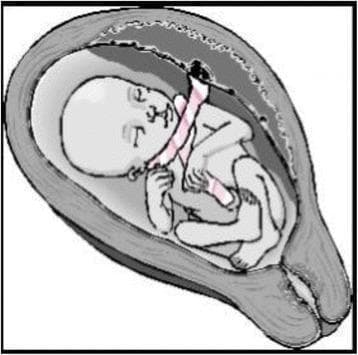 This medical illustration depicts an anatomical diagram of a fetus in utero demonstrating a nuchal cord with a 'free sliding pattern'. The fetus is shown in a flexed, cephalic presentation within the uterine cavity. The umbilical cord is visibly coiled around the fetal neck in at least two loose loops. These loops are characterized by a lack of constriction or indentation of the fetal soft tissues, representing a 'Type A' nuchal cord configuration where the cord can move freely and potentially undo itself spontaneously. The placenta is positioned at the fundal/posterior aspect of the uterus, with the cord extending toward the neck before reaching the umbilicus. This diagram serves as an educational tool in obstetrics to differentiate between non-constricting (Type A) and locked/constricting (Type B) nuchal cord patterns, highlighting the clinical relevance of cord entanglement and its impact on fetal well-being during gestation and labor.