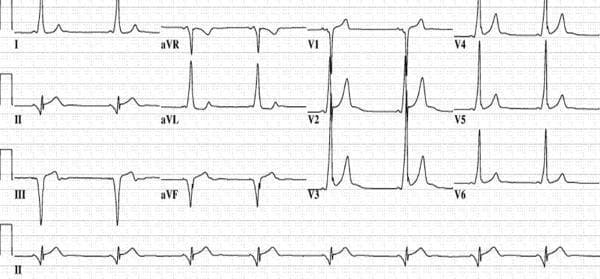 This diagnostic image is a 12-lead electrocardiogram (ECG) demonstrating the classic pre-excitation pattern of Wolff-Parkinson-White (WPW) syndrome associated with a posteroseptal accessory pathway. Key features include a shortened PR interval and the presence of delta waves—slurred upstrokes at the start of the QRS complexes. In the precordial leads, the delta wave is positive in V1, becomes less prominent in V2, and disappears by V3. Crucially, the delta waves are negative in the inferior leads (II, III, and aVF), mimicking a pseudo-infarct Q-wave pattern. This negative polarity in the inferior leads is highly suggestive of an accessory pathway originating in the posteroseptal region, potentially localized near the coronary sinus or middle cardiac vein. The tracing serves as an educational tool for medical students and electrophysiologists to practice electrocardiographic localization of bypass tracts prior to catheter ablation.