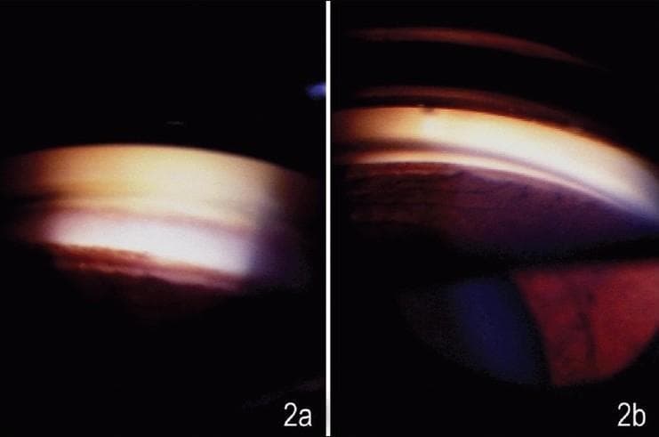 This side-by-side clinical photograph displays two gonioscopic images (labeled 2a and 2b) of the anterior chamber angle of a human eye, illustrating the diagnostic technique of indentation gonioscopy. Image 2a shows the angle as viewed with a Sussman (four-mirror) lens during indentation. In this frame, the previously suspected peripheral anterior synechia (PAS) has disappeared, revealing a widely open angle with clearly visible, smooth trabecular meshwork and iris insertion. Image 2b shows the angle through a Goldmann (two-mirror) lens. In this view, a 'pseudofalse' synechia persists despite manipulative attempts, manifesting as a dark, iris-like structure that appears to bridge the angle toward the Schwalbe's line. The comparison demonstrates how indentation gonioscopy can differentiate true synechia from peripheral iris bulges seen 'end-on'. This is a critical diagnostic distinction in the management of glaucoma and narrow-angle conditions, where true synechial closure must be identified for appropriate treatment planning.