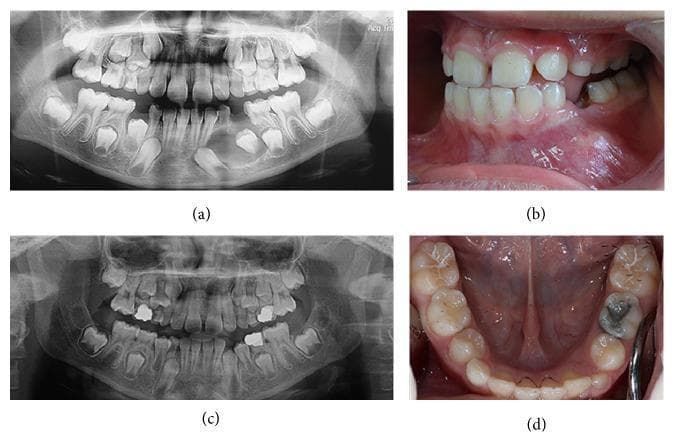 A multi-panel clinical figure showing diagnostic imaging and intraoral photographs of a pediatric patient with a dentigerous cyst (DC). Panel (a) is a baseline panoramic radiograph (orthopantomogram) of a mixed dentition, revealing a well-defined, unilocular radiolucency in the left mandibular region associated with the crown of an unerupted permanent tooth, causing tooth displacement. Panel (b) shows a corresponding clinical photograph of the left mandible with visible alveolar swelling and erythematous mucosa. Panels (c) and (d) provide 12-month follow-up views. The follow-up radiograph (c) demonstrates significant bone regeneration, resolution of the cystic radiolucency, and progression of tooth eruption. The occlusal intraoral photograph (d) shows the successful eruption of the previously affected permanent teeth into the oral cavity with healthy gingival tissue. The series illustrates the clinical management and healing of an odontogenic cyst in a pediatric patient within the specialty of pediatric dentistry and oral maxillofacial surgery.
