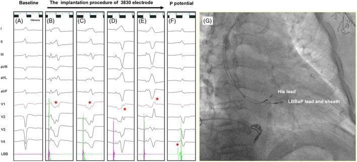 This composite educational image illustrates the procedure for left bundle branch area pacing (LBBaP) using a 3830 lead. Panels A–F present 12-lead electrocardiogram (ECG) and intracardiac electrogram (EGM) tracings. Panel A shows baseline ECG. Panels B–E demonstrate the dynamic evolution of the QRS morphology in lead V1 as the electrode is screwed into the interventricular septum. Initially, a 'W-shaped' QRS with a mid-notch is observed (red star, panel B). As the lead advances, this notch migrates toward the end of the QRS complex (panels C–D) until a terminal R' wave emerges (panel E), creating a right bundle branch block (RBBB) pattern indicative of successful capture of the left bundle branch system. Panel F identifies the Purkinje (P) potential (red dot) on the local EGM. Panel G is a fluoroscopic image in a right anterior oblique (RAO) view showing the anatomical positioning of the 'His lead' and the 'LBBaP lead and sheath,' demonstrating the LBBaP lead's location slightly inferior and distal to the His-bundle region.
